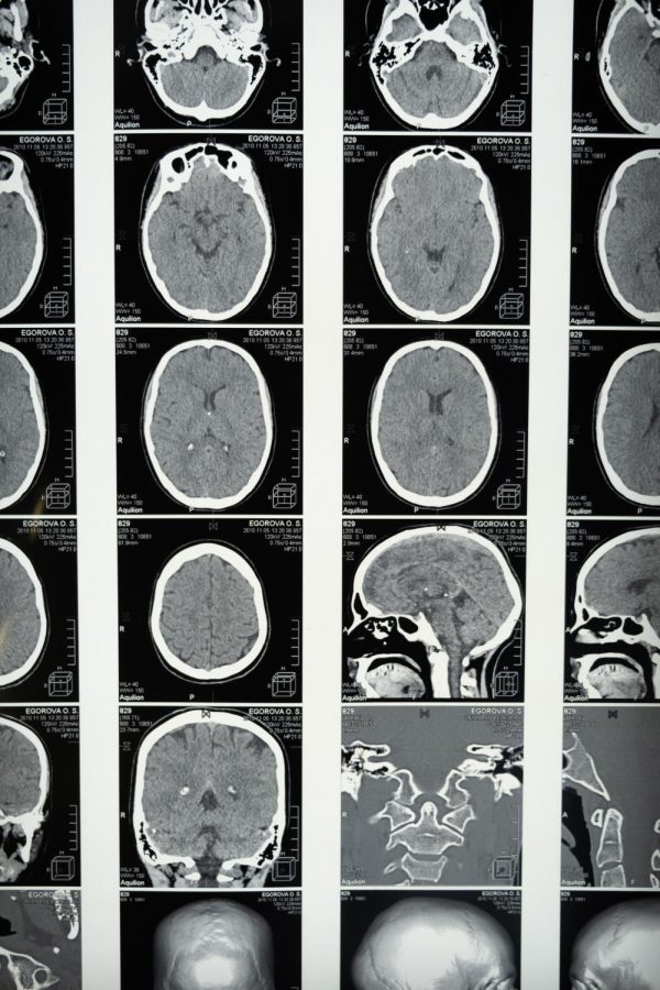 Brain scans are seen being displayed. https://www.pexels.com/photo/medical-imaging-of-the-brain-5723875/